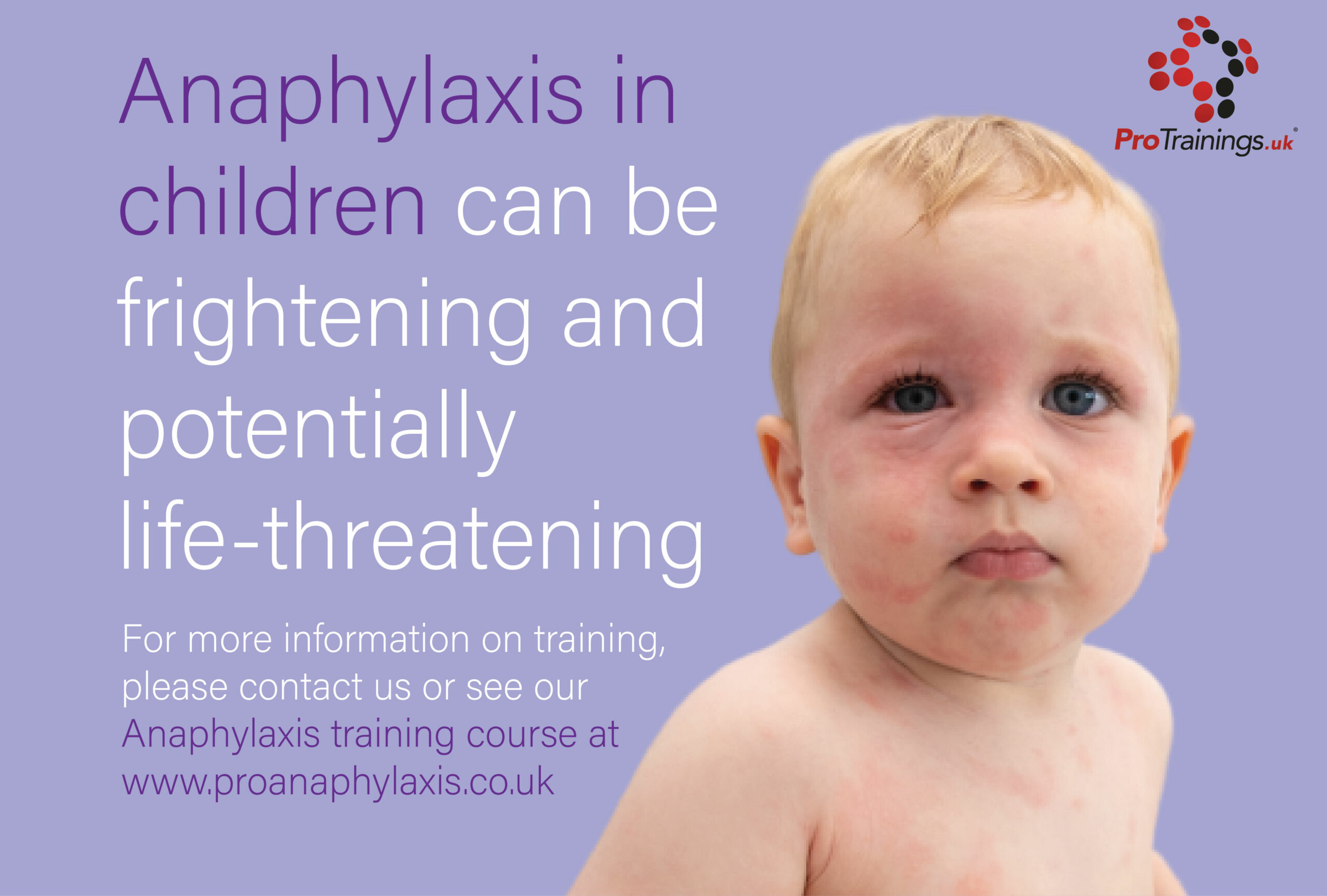 anaphylactic-reactions-in-children